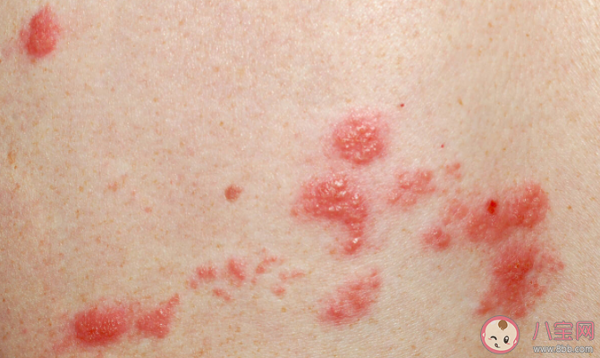 带状疱疹疫苗到底有没有必要打 带状疱疹疫苗为什么那么贵 带状疱疹疫苗到底有没有必要打 带状疱疹疫苗为什么那么贵