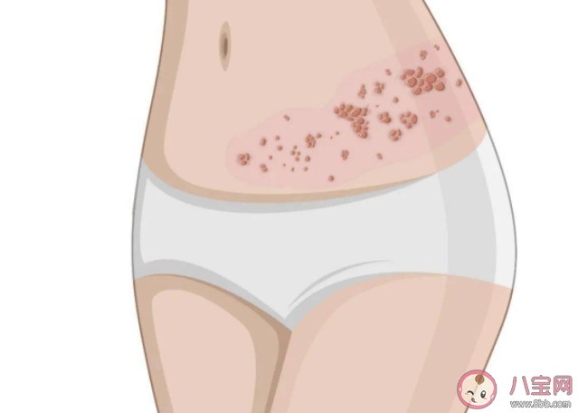 带状疱疹疫苗到底有没有必要打 带状疱疹疫苗为什么那么贵 带状疱疹疫苗到底有没有必要打 带状疱疹疫苗为什么那么贵