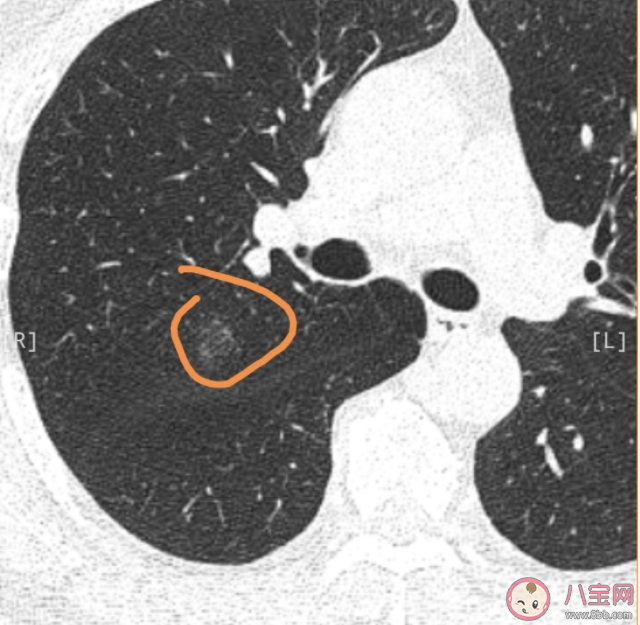 哪些行为会增加患乳腺结节的风险 患乳腺结节后会有哪些症状