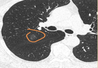 哪些行为会增加患乳腺结节的风险 患乳腺结节后会有哪些症状