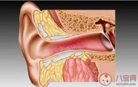 外耳道炎是什么原因导致的 患外耳道炎应该怎么办