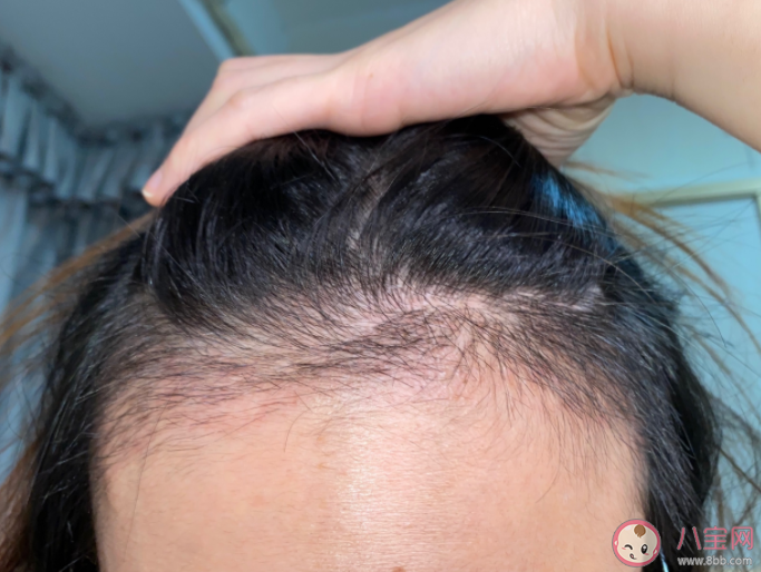父母秃头孩子也会秃头吗 为什么男生比女生容易秃