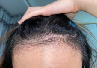 父母秃头孩子也会秃头吗 为什么男生比女生容易秃