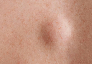 脂肪瘤的症状有哪些 为什么会长脂肪瘤