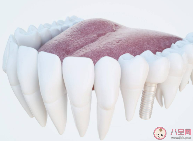 根管治疗有多复杂 根管治疗要花多少钱 根管治疗有多复杂 根管治疗要花多少钱