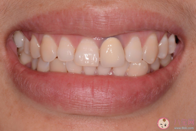 根管治疗有多复杂 根管治疗要花多少钱 根管治疗有多复杂 根管治疗要花多少钱