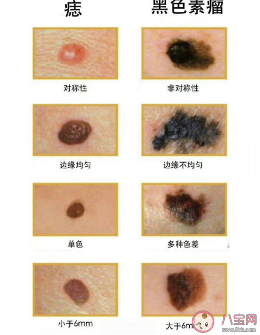 如何区分痣和黑色素瘤 长在什么部位的痣要多当心 如何区分痣和黑色素瘤 长在什么部位的痣要多当心