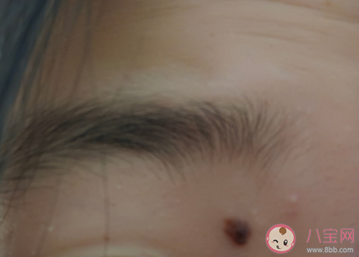 如何区分痣和黑色素瘤 长在什么部位的痣要多当心 如何区分痣和黑色素瘤 长在什么部位的痣要多当心