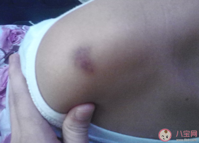 什么样的淤青需重视 哪些淤青要警惕