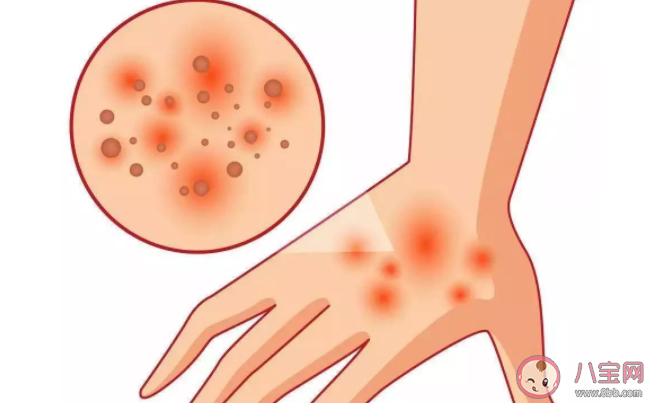 神经性皮炎和什么有关 神经性皮炎有传染性吗