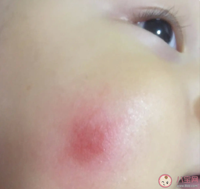 蚊虫叮咬对身体有什么危害 蚊子喜欢咬什么人