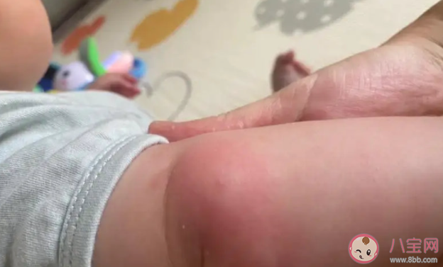 蚊虫叮咬对身体有什么危害 蚊子喜欢咬什么人