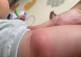 蚊虫叮咬对身体有什么危害 蚊子喜欢咬什么人