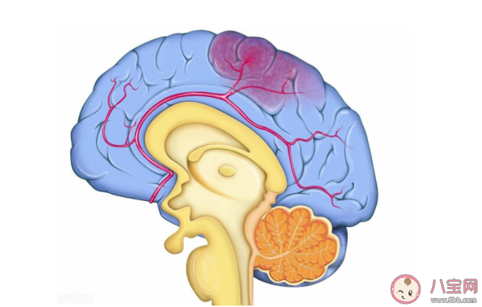 哪些人是脑出血高危人群 突发脑出血怎么急救
