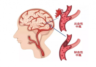 26岁女子长期熬夜导致脑出血 脑出血是怎么发生的