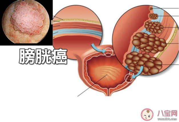 为什么男性更容易膀胱癌 膀胱癌的早期症状有哪些