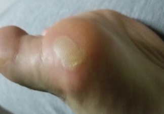 脚上磨起了泡要不要挑破 为什么脚容易磨出水泡