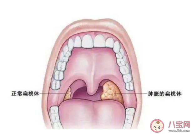 爱发炎的扁桃体到底有啥用 如何预防扁桃体发炎