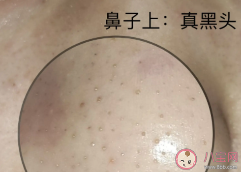 脸上黑头真的需要清洁吗 该怎样去除黑头