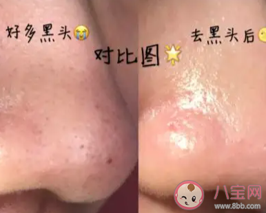 脸上黑头真的需要清洁吗 该怎样去除黑头