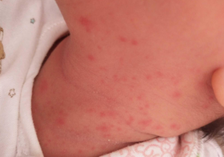 桃子水是祛痱神器吗 宝宝防痱指南