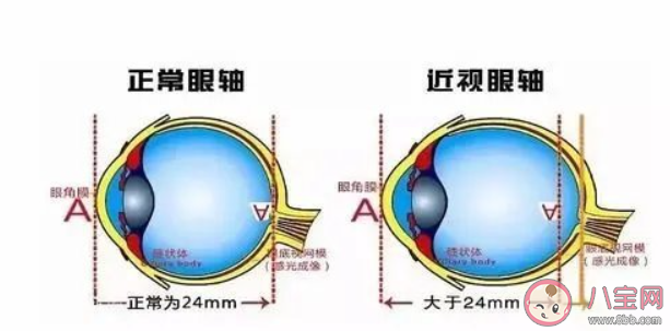 高度近视产生的眼底病变不可逆 病理性近视是怎样的