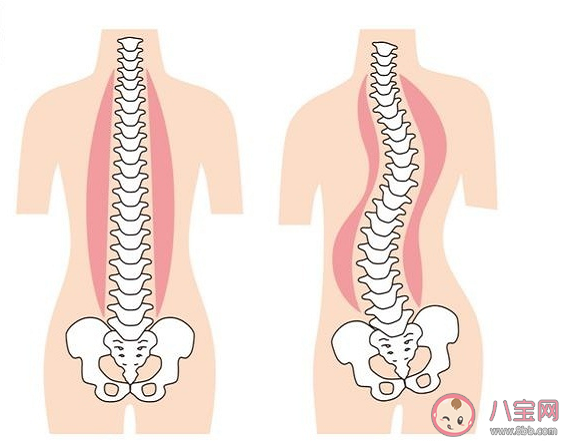 孩子脊柱侧弯是小问题吗 脊柱侧弯还有救吗