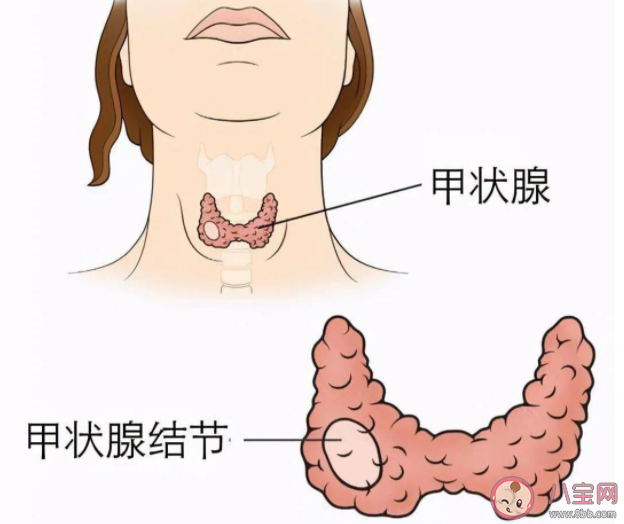 发现甲状腺结节必须做穿刺活检吗 甲状腺穿刺活检是怎么做的