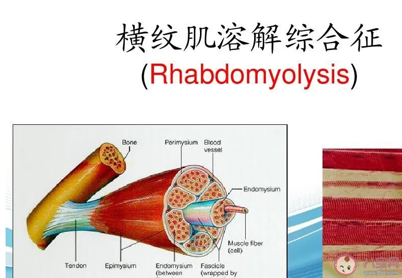 横纹肌溶解怎么造成的 为什么过度运动会引起横纹肌溶解