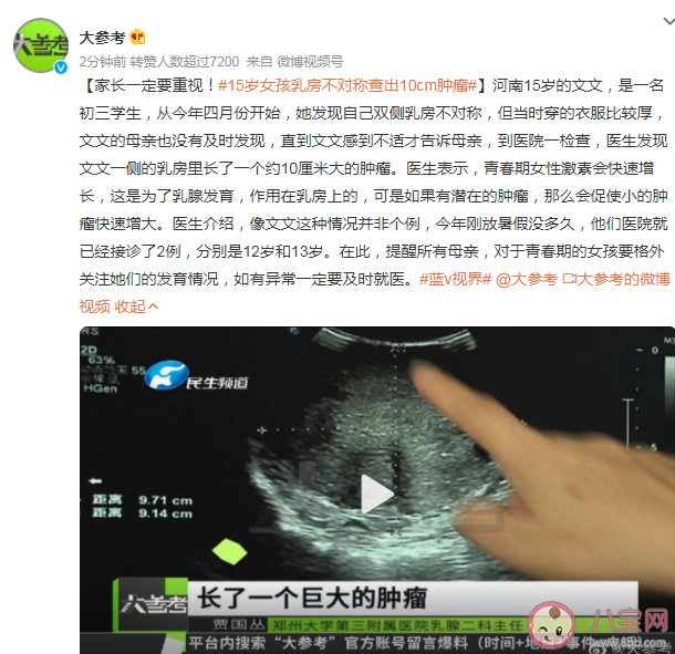 15岁女孩乳房不对称查出10cm肿瘤 需要注意突然不对称的乳房