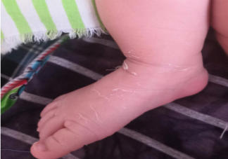 孩子手脚脱皮等于缺乏维生素吗 孩子手脚脱皮是什么原因