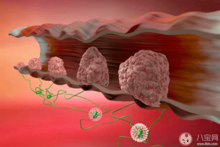 肠息肉切掉了为什么 还会复发 肠道为什么会长息肉