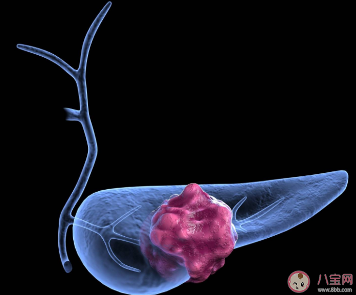 胰腺癌为何被称为癌中之王 如何远离胰腺癌
