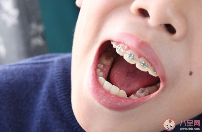 孩子爱护牙齿经验小妙招 牙齿清理有哪些容易被人忽略的