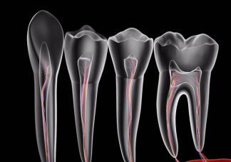 根管治疗后为什么还需要做牙冠 做根管治疗后要注意什么问题