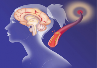 为什么天冷会诱发脑卒中 预防心脑血管疾病发生要从这5个方面入手