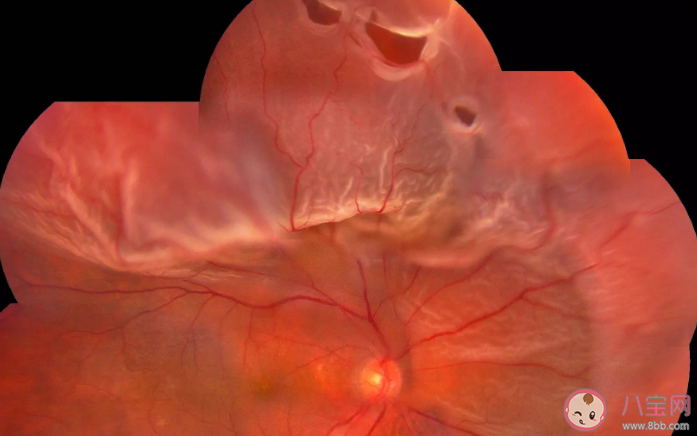 考研女生用眼过度视网膜裂孔 视网膜裂孔有什么症状