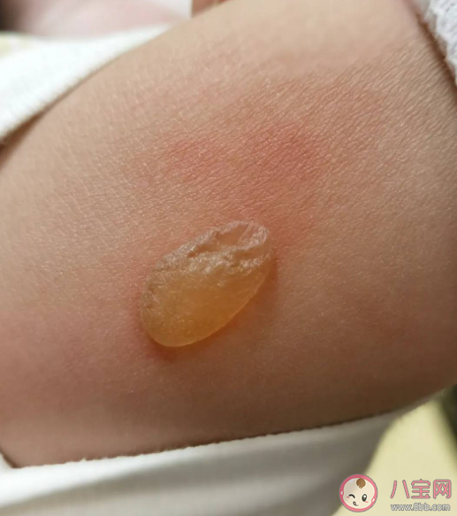 冬天哪些取暖工具容易低温烫伤 低温烫伤有多严重