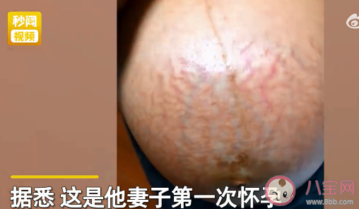 男子称妻子孕肚像被蜈蚣爬满太恐怖 妊娠纹该如何消除