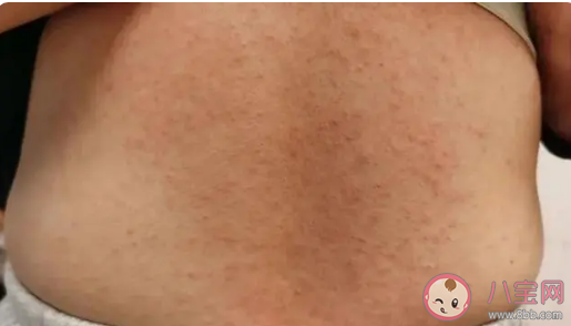 女子混吃7种感冒止咳药全身长满脓疱是怎么回事 多种药物混吃有什么危害