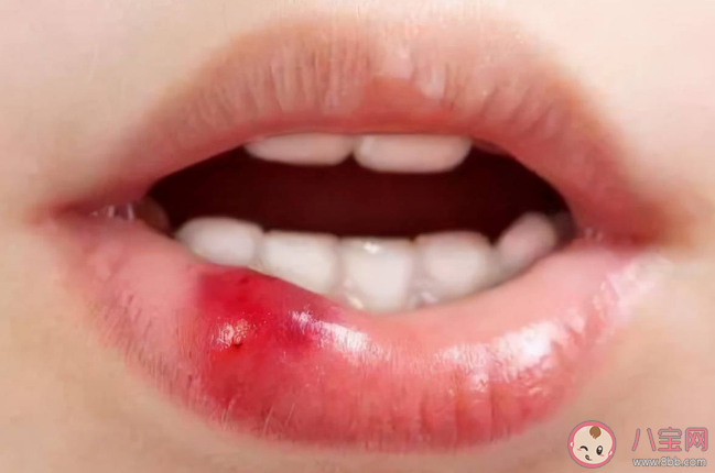 经常烂嘴角可能是免疫力差 如何科学提高自身的免疫力