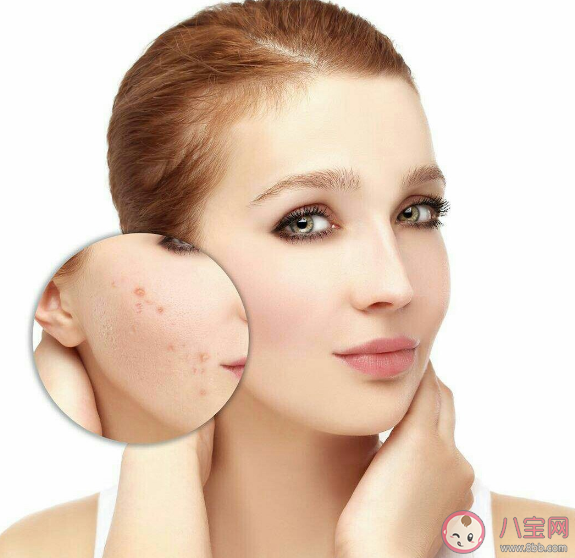 痘坑只能靠医美去掉吗 什么痘痘容易造成痘印痘坑