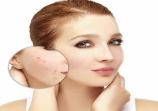 痘坑只能靠医美去掉吗 什么痘痘容易造成痘印痘坑