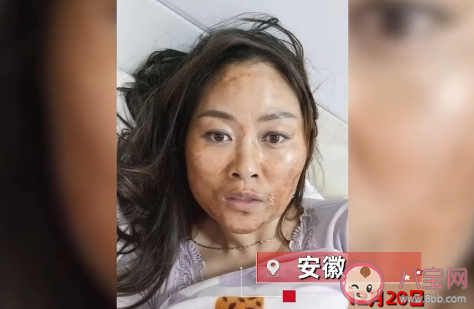 女子感染新冠高烧后满脸发黑是怎么回事 一般感染新冠会有哪些症状