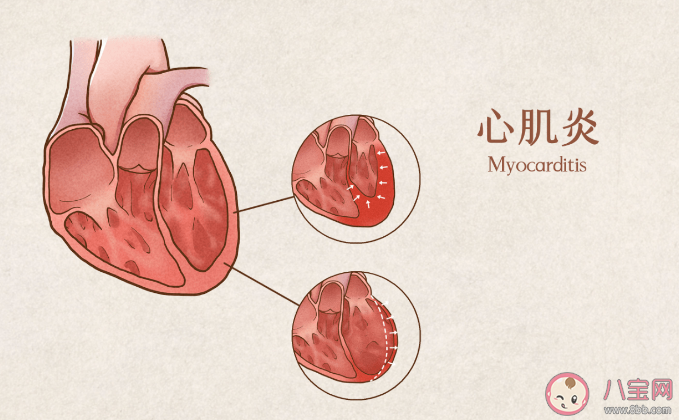 阳过后你有心肌炎症状吗 心肌炎有什么症状和表现