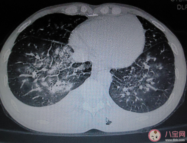 感染新冠会变白肺吗 阳后有必要拍肺部CT吗