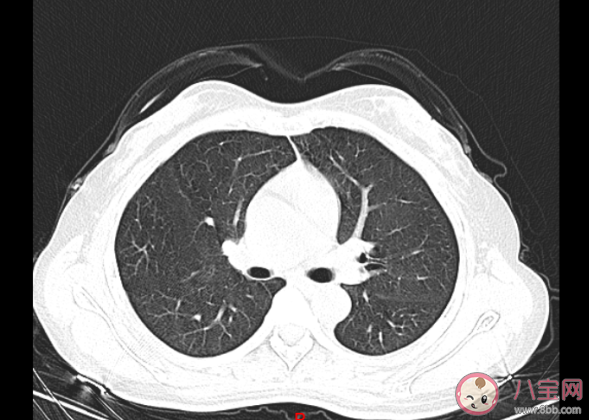 阳后有必要拍肺部CT吗 阳后怎样判断肺部有没有问题