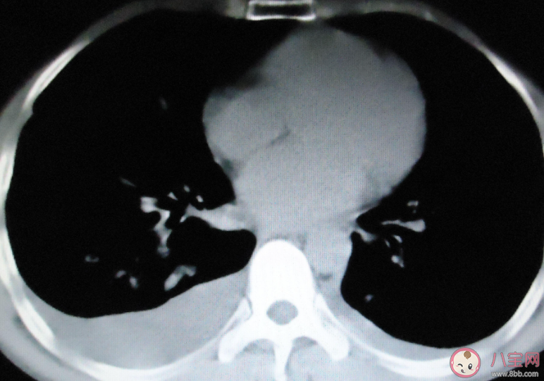 阳后有必要拍肺部CT吗 阳后怎样判断肺部有没有问题