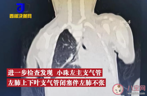 1岁娃吃松子摔倒卡进气管脸憋紫是怎么回事 一岁的孩子不能吃什么