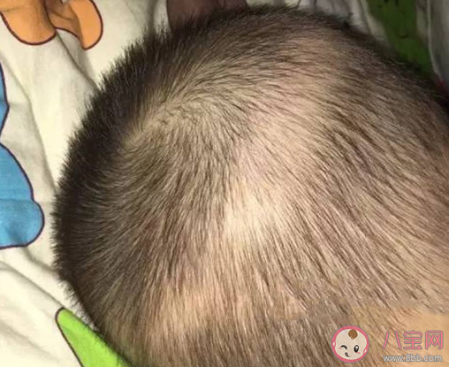 1岁多孩子经常掉头发是怎么回事 宝宝脱发会变成秃子吗 1岁多孩子经常掉头发是怎么回事 宝宝脱发会变成秃子吗